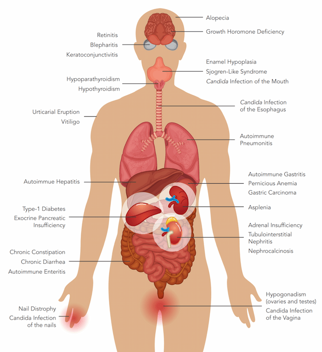 Common APECED symptoms and the organs they affect.